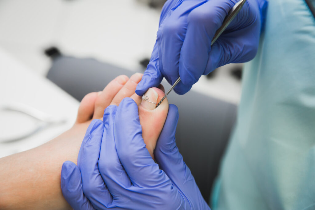 How to Properly Treat Ingrown Nails with Podiatry Supplies
