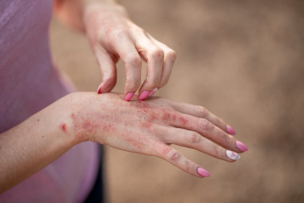 Hand Dermatitis at Work: Causes and Prevention